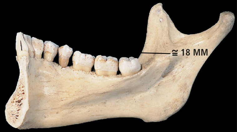 Osso mandíbula (aspecto dorsal).