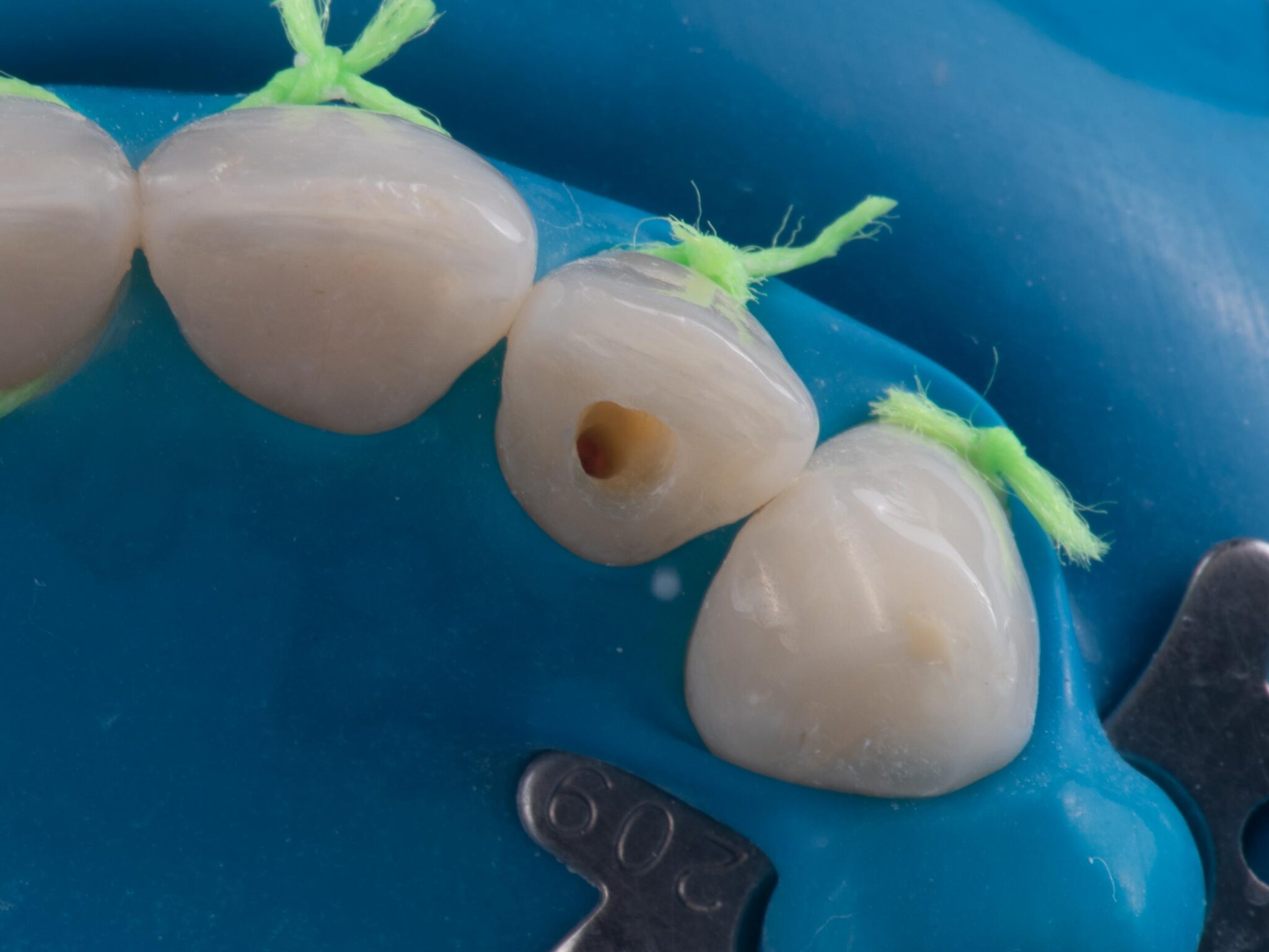 Vente de 10Pcs Modèle de dents Endo de pratique RCT du canal radiculaire endodontique dentaire en ligne